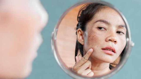 سیستئامین چیست و چرا بهترین ماده برای از بین بردن لک های پوستی است؟