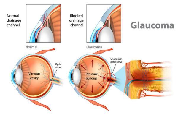 15 دانستنی جالب و ضروری در خصوص بیماری گلوکوم (Glaucoma) یا آب سیاه