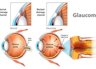 15 دانستنی جالب و ضروری در خصوص بیماری گلوکوم (Glaucoma) یا آب سیاه